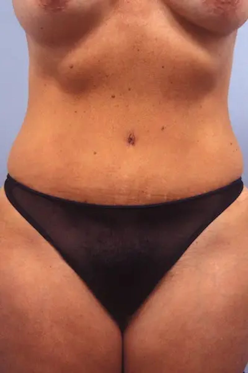 Tummy Tuck Before & After Gallery - Patient 205861 - Image 2