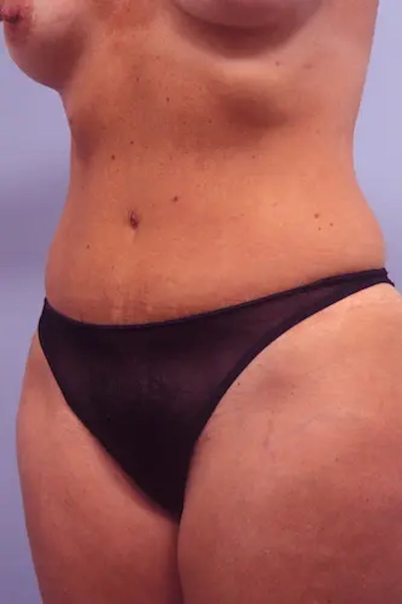 Tummy Tuck Before & After Gallery - Patient 205861 - Image 4