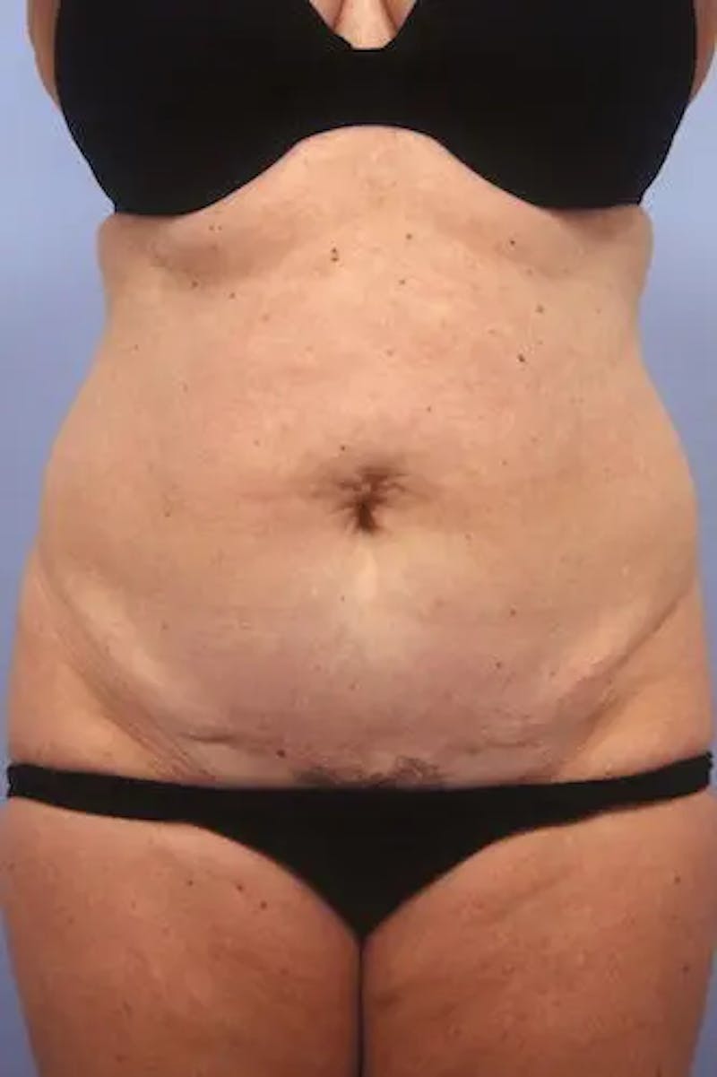 Tummy Tuck Before & After Gallery - Patient 406946 - Image 1