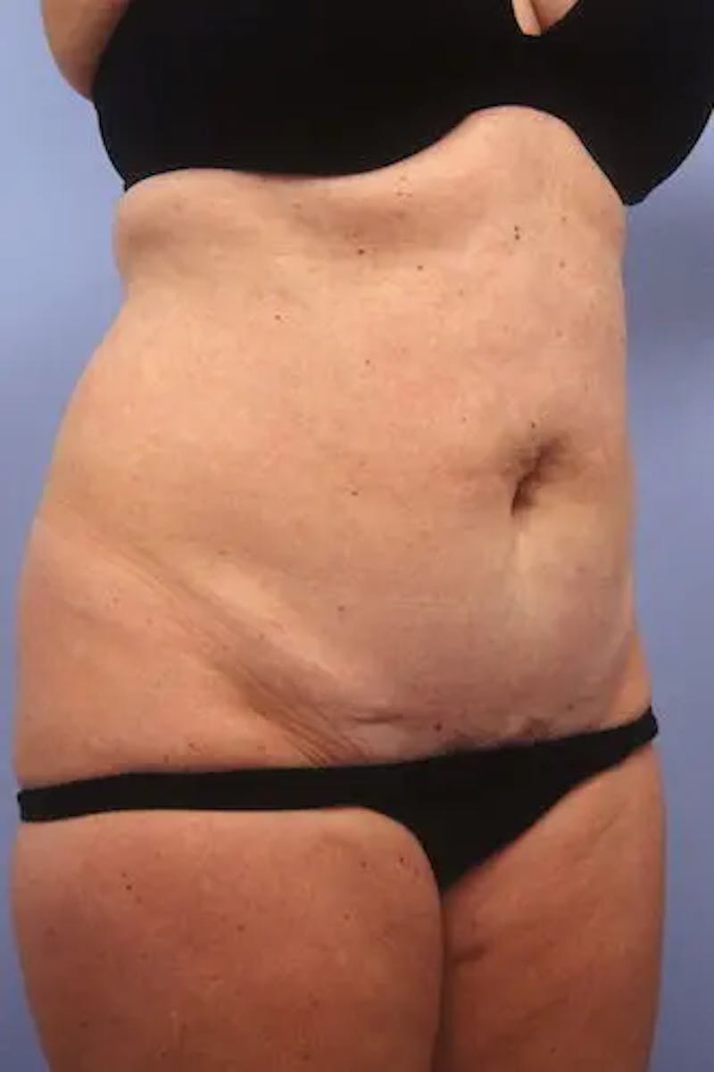 Tummy Tuck Before & After Gallery - Patient 406946 - Image 3