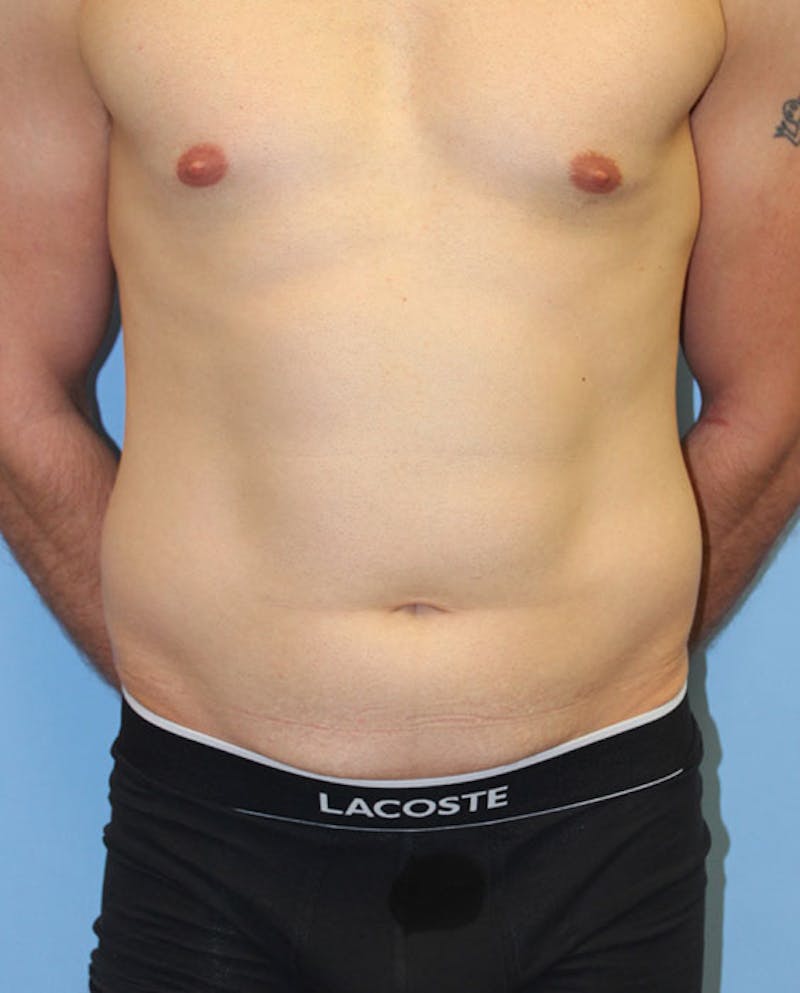 Tummy Tuck Before & After Gallery - Patient 132257 - Image 1