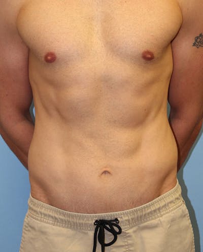 Tummy Tuck Before & After Gallery - Patient 132257 - Image 2