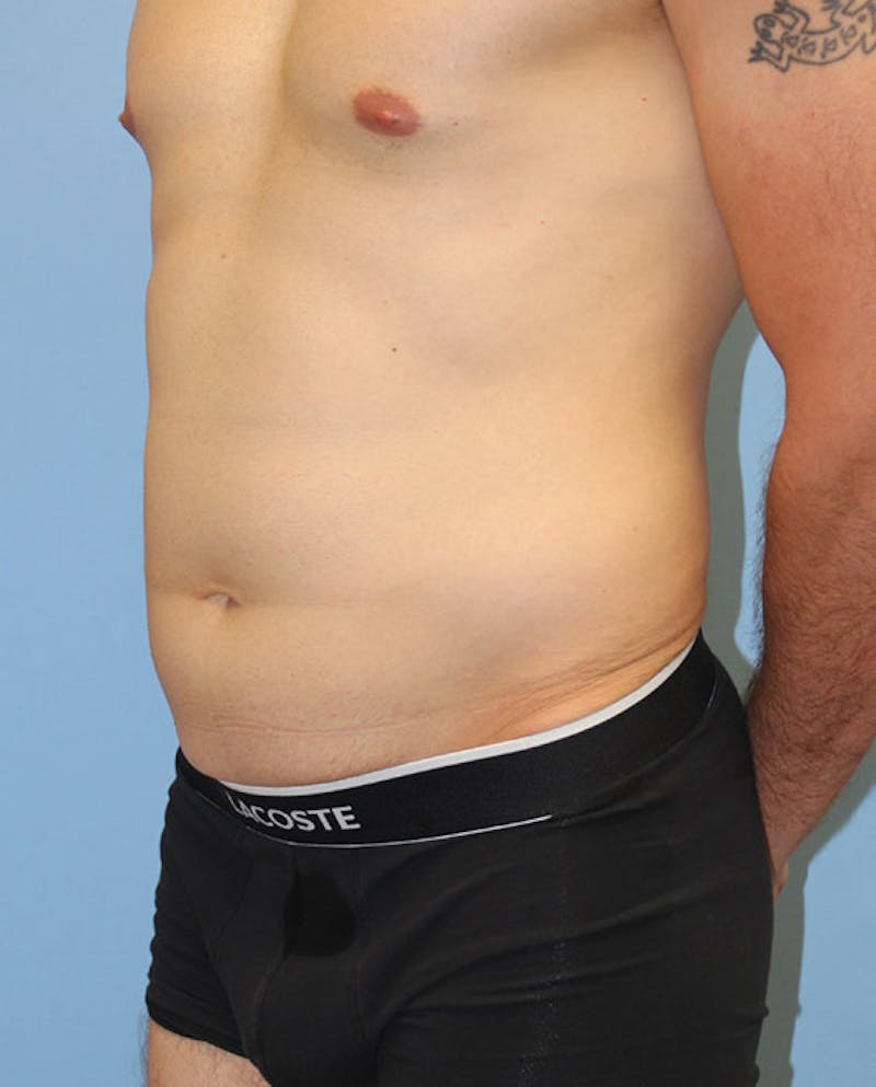 Tummy Tuck Before & After Gallery - Patient 132257 - Image 3