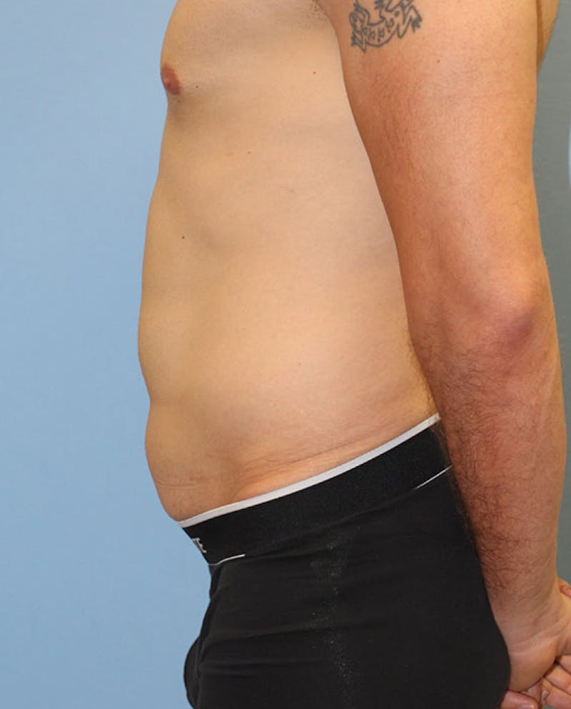 Tummy Tuck Before & After Gallery - Patient 132257 - Image 5
