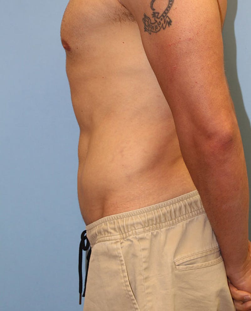 Tummy Tuck Before & After Gallery - Patient 132257 - Image 6