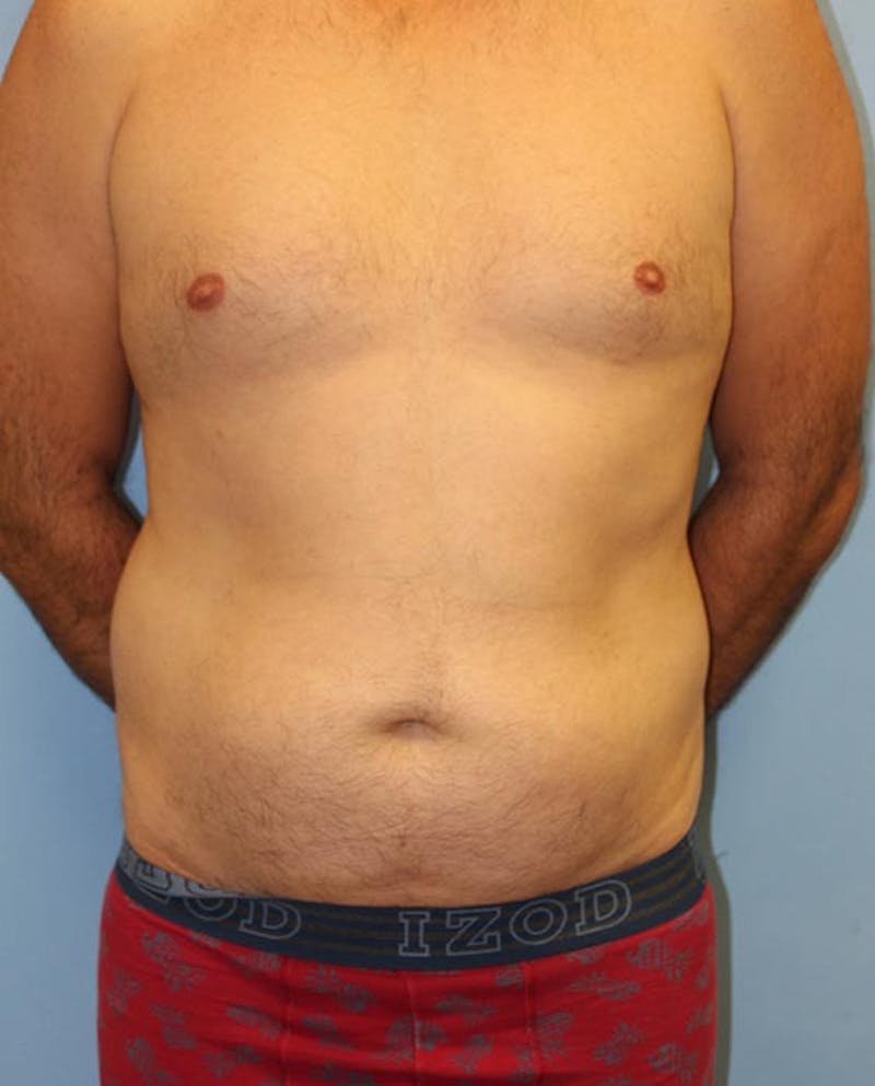 Tummy Tuck Before & After Gallery - Patient 282875 - Image 1