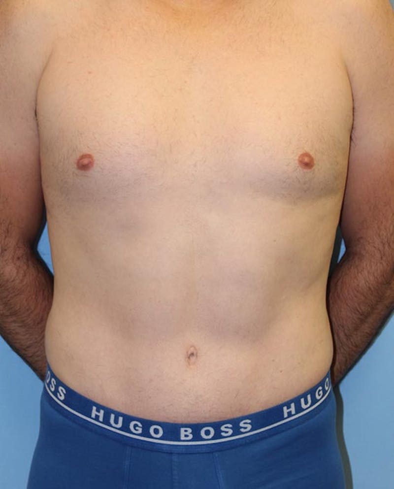 Tummy Tuck Before & After Gallery - Patient 282875 - Image 2