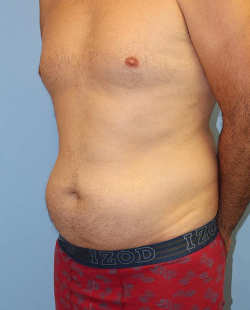 Tummy Tuck Before & After Gallery - Patient 282875 - Image 3