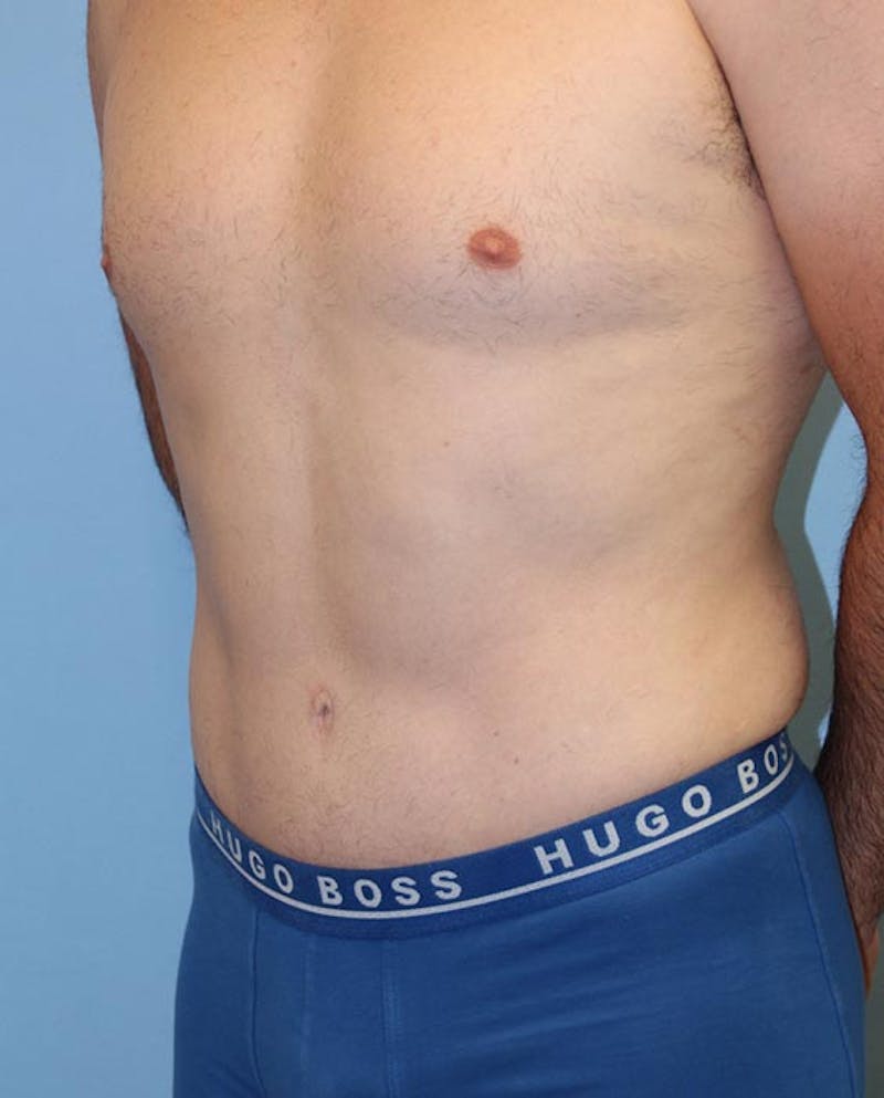 Tummy Tuck Before & After Gallery - Patient 282875 - Image 4