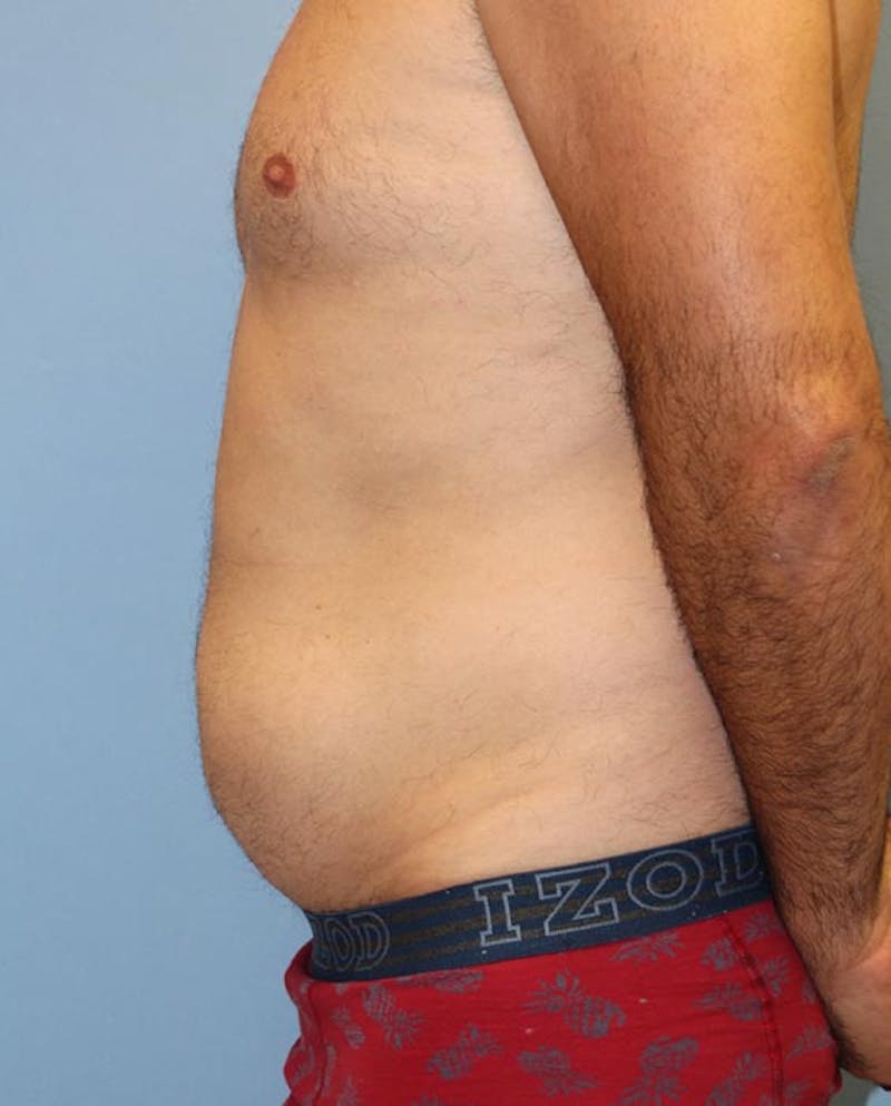 Tummy Tuck Before & After Gallery - Patient 282875 - Image 5