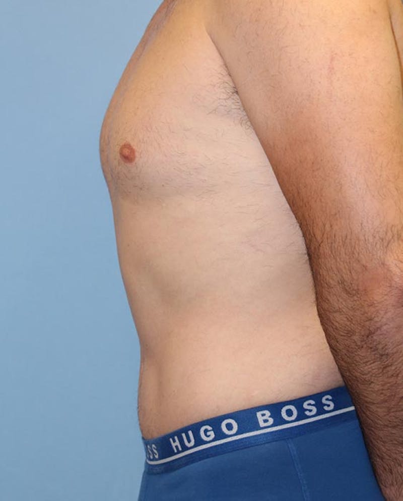 Tummy Tuck Before & After Gallery - Patient 282875 - Image 6