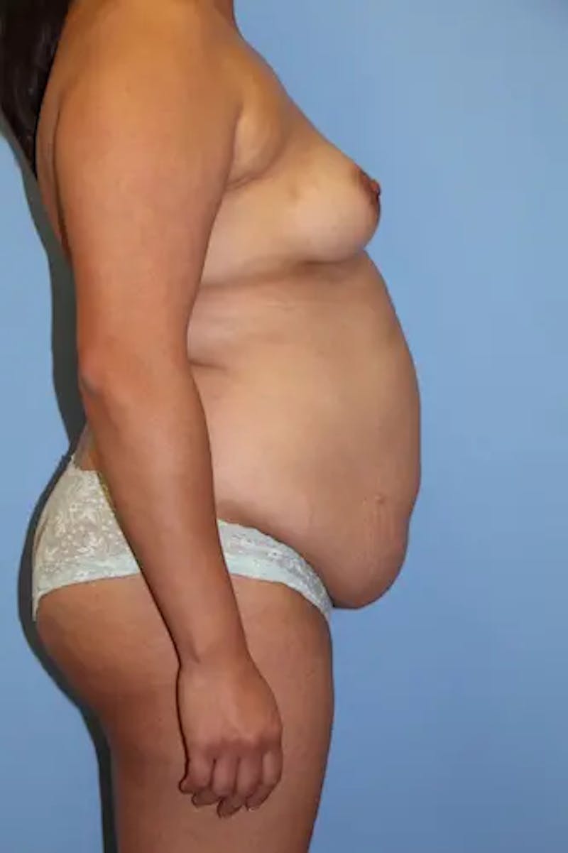 Mommy Makeover Before & After Gallery - Patient 326713 - Image 5