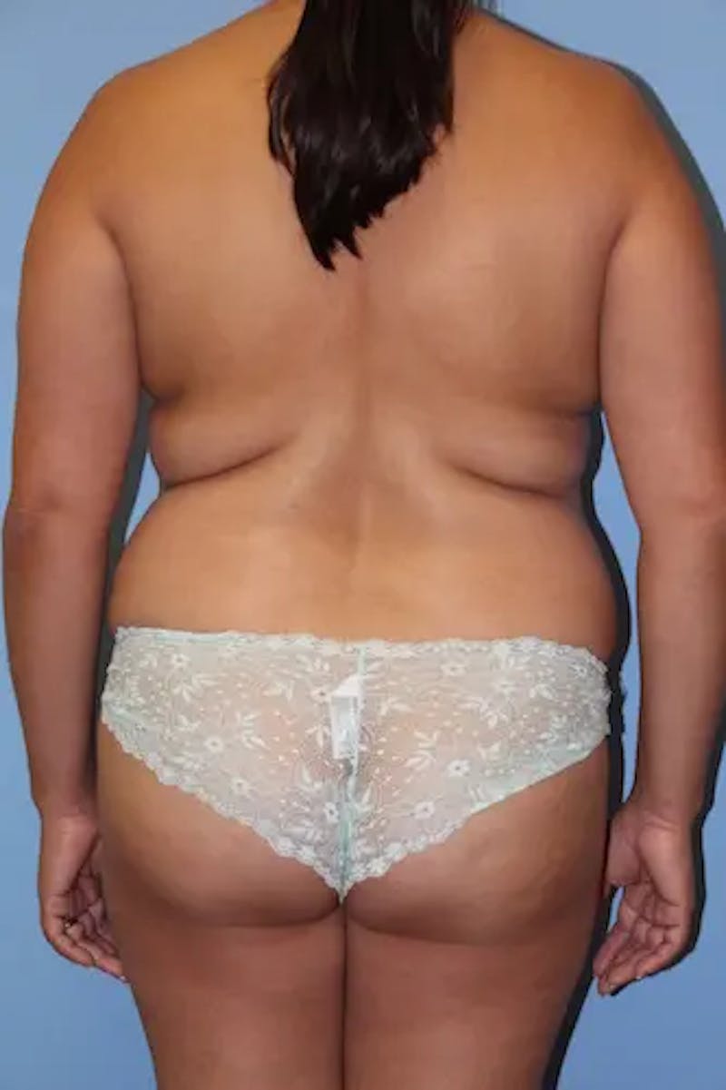 Mommy Makeover Before & After Gallery - Patient 326713 - Image 7