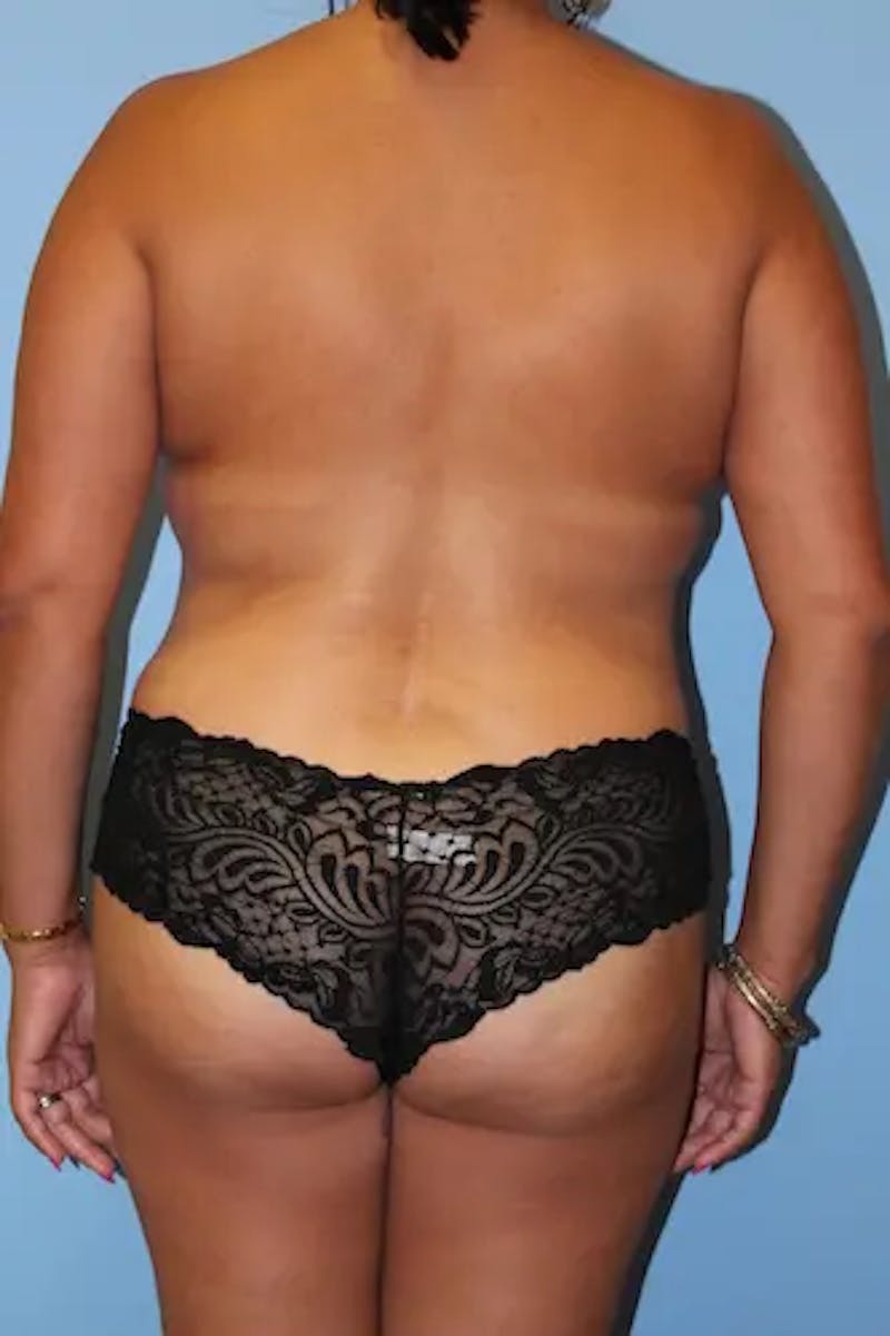 Mommy Makeover Before & After Gallery - Patient 326713 - Image 8