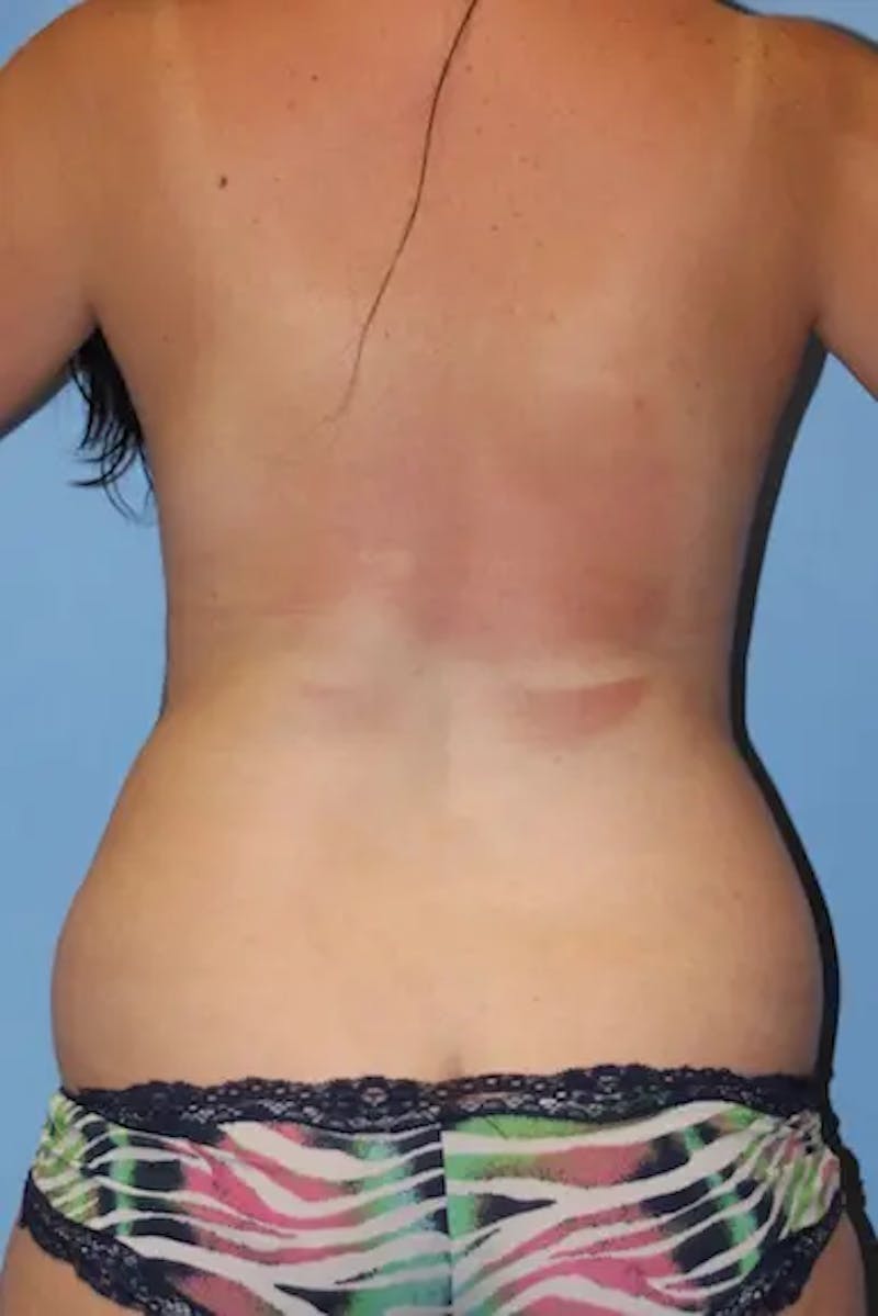 Mommy Makeover Before & After Gallery - Patient 410296 - Image 7