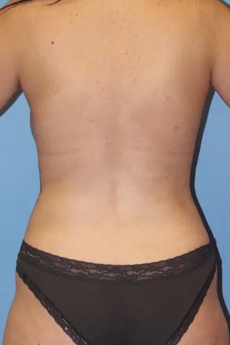 Mommy Makeover Before & After Gallery - Patient 410296 - Image 8