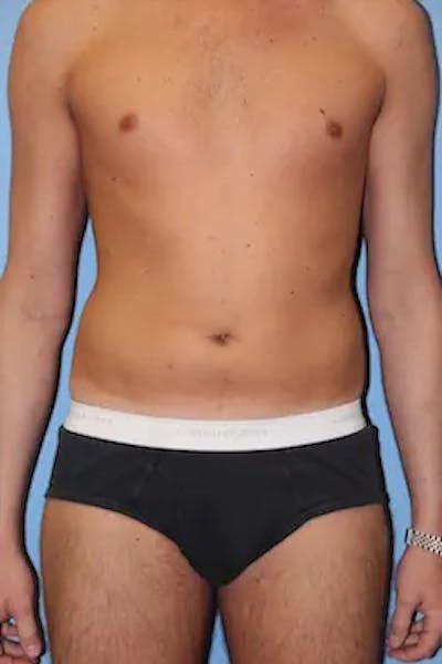 Liposuction Before & After Gallery - Patient 858464 - Image 1