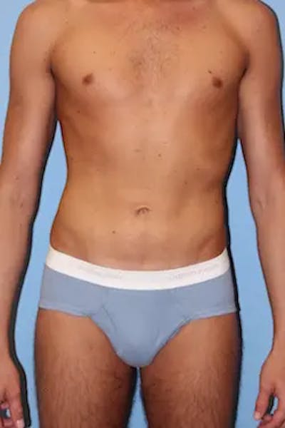 Liposuction Before & After Gallery - Patient 858464 - Image 2