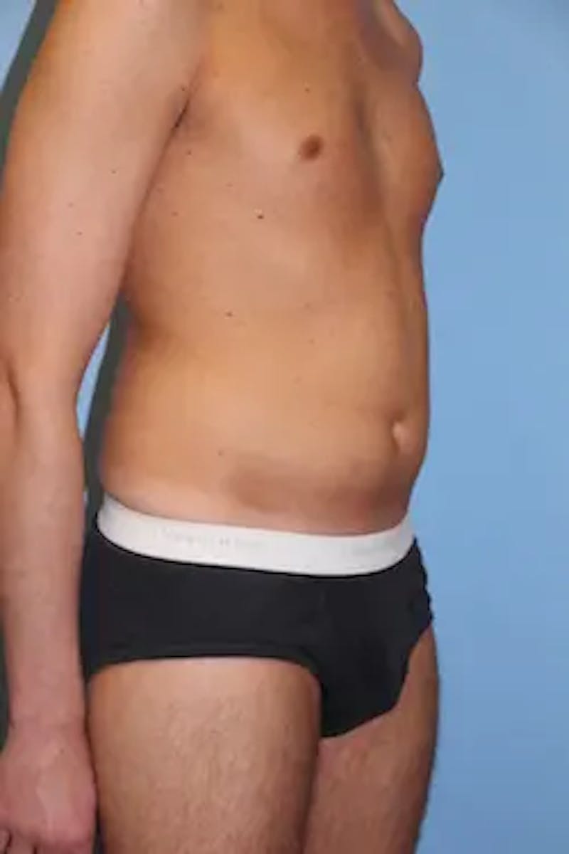 Liposuction Before & After Gallery - Patient 858464 - Image 3