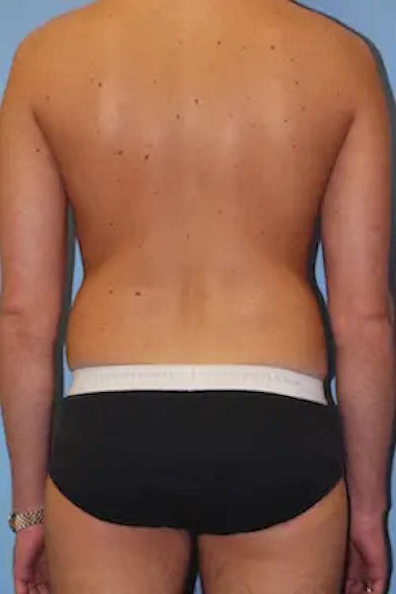 Liposuction Before & After Gallery - Patient 858464 - Image 7