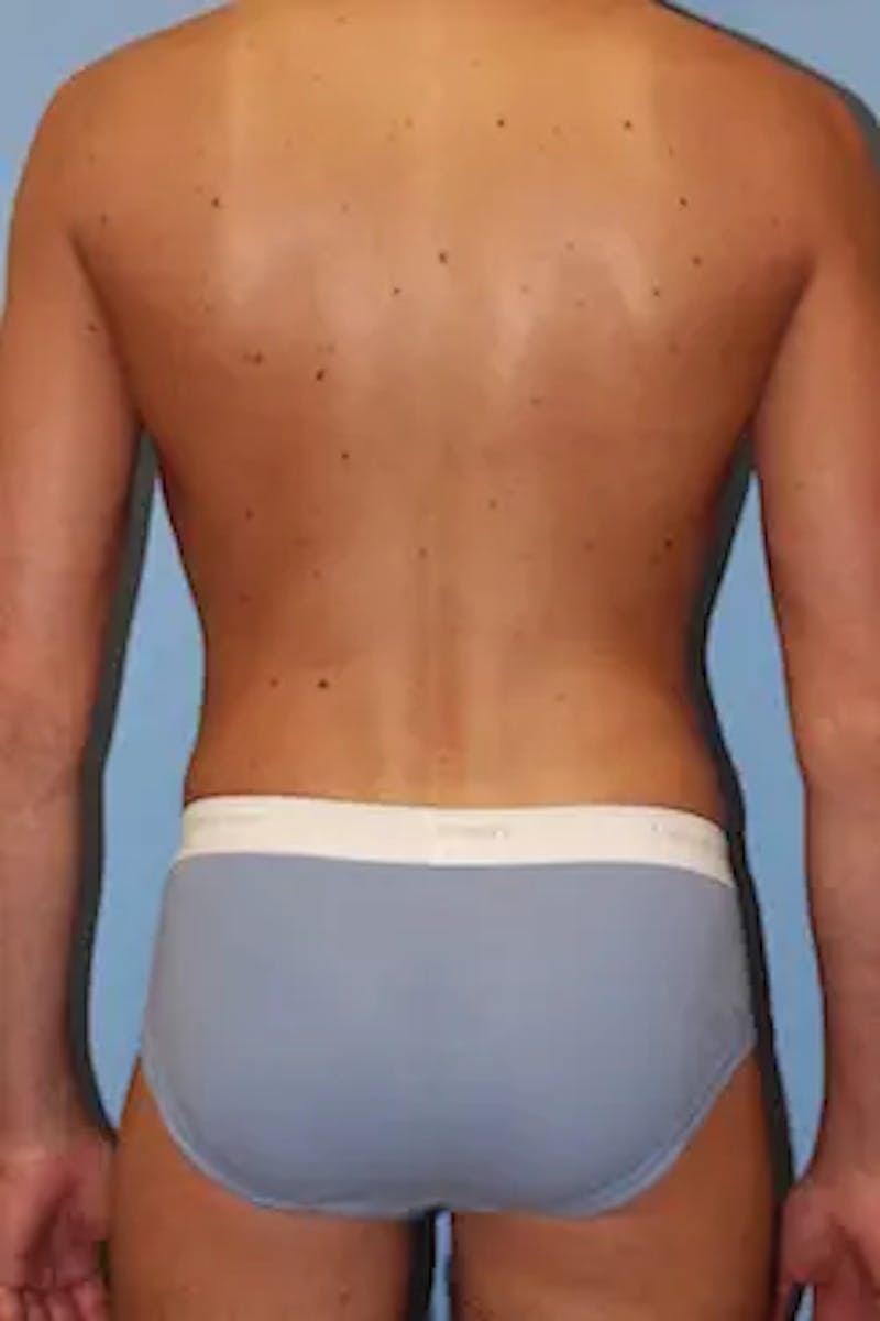 Liposuction Before & After Gallery - Patient 858464 - Image 8