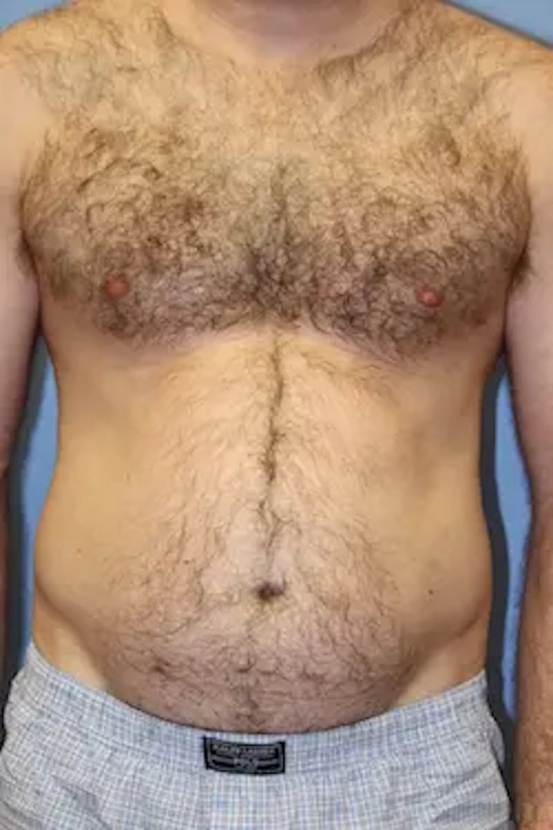 Liposuction Before & After Gallery - Patient 913584 - Image 1