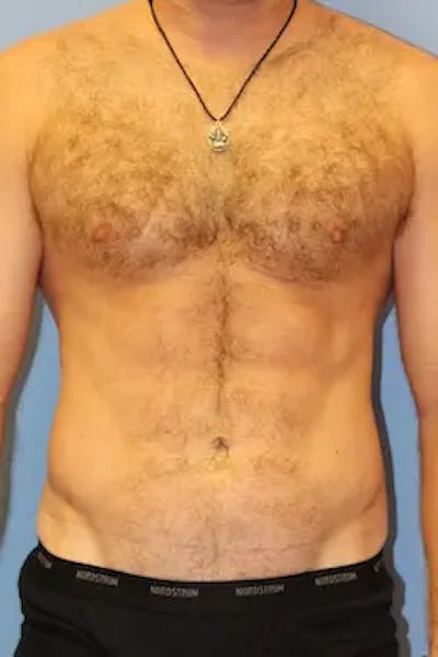 Liposuction Before & After Gallery - Patient 913584 - Image 2