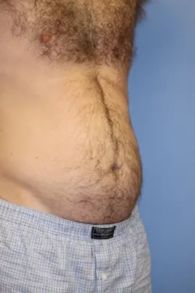 Liposuction Before & After Gallery - Patient 913584 - Image 3