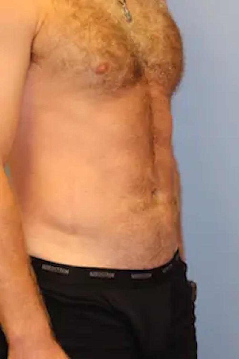 Liposuction Before & After Gallery - Patient 913584 - Image 4