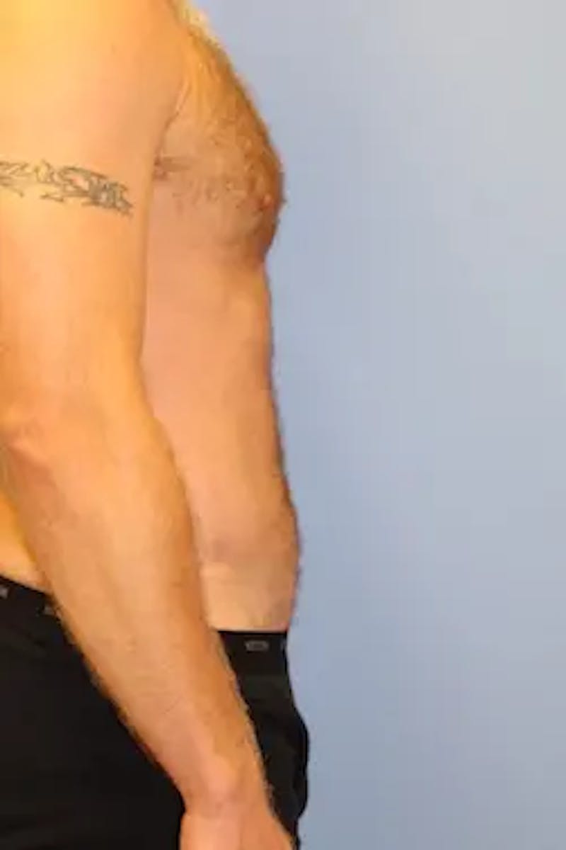 Liposuction Before & After Gallery - Patient 913584 - Image 6