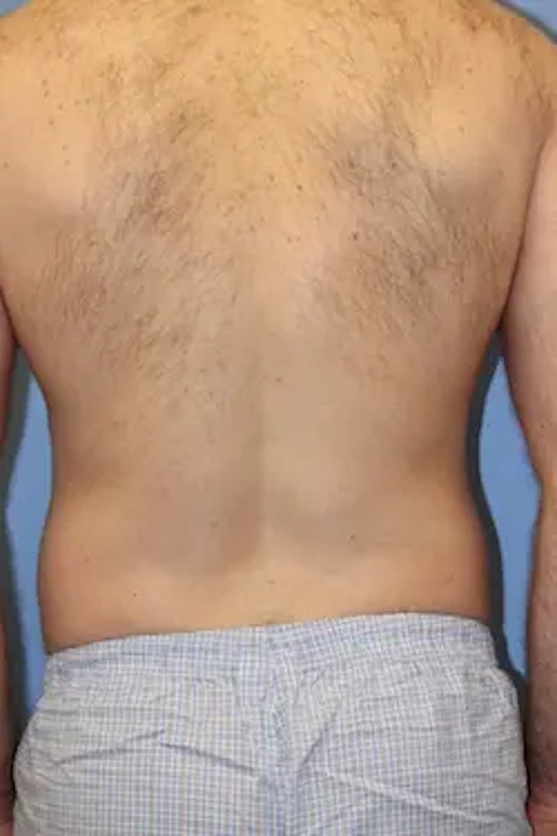 Liposuction Before & After Gallery - Patient 913584 - Image 7
