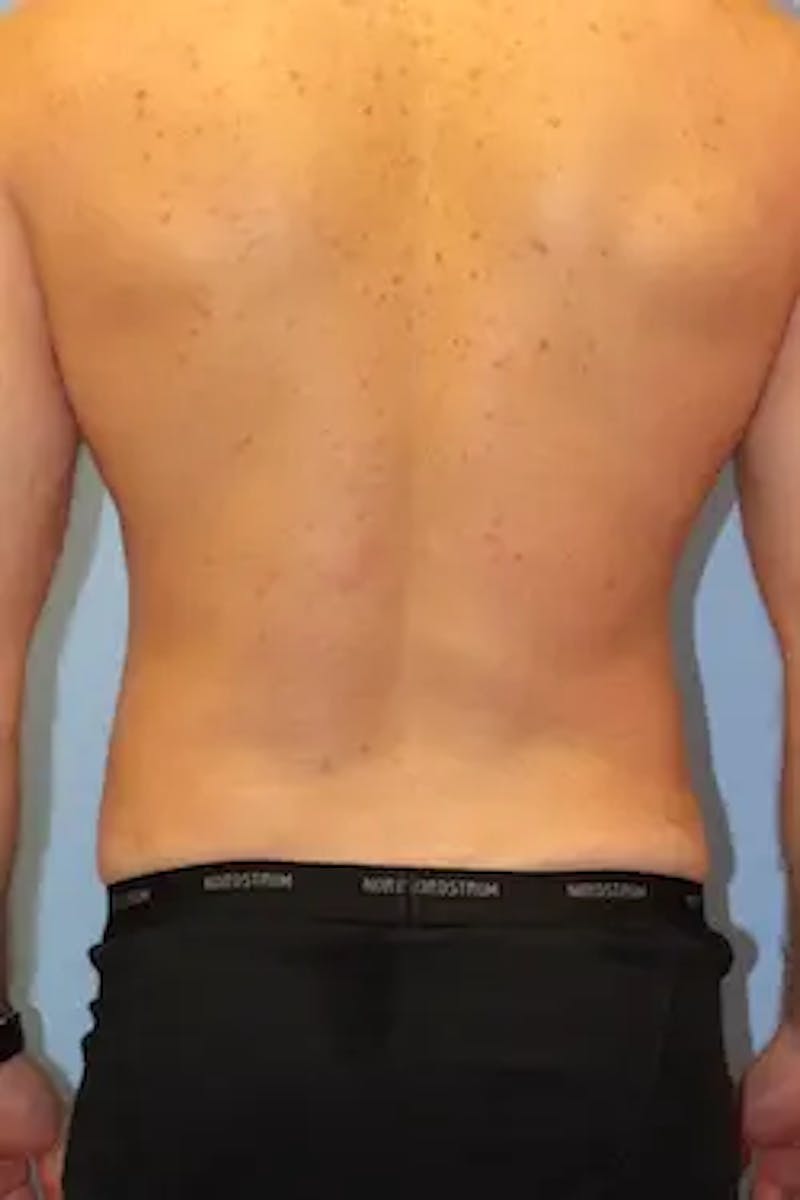 Liposuction Before & After Gallery - Patient 913584 - Image 8