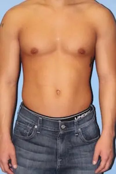 Liposuction Before & After Gallery - Patient 269893 - Image 1