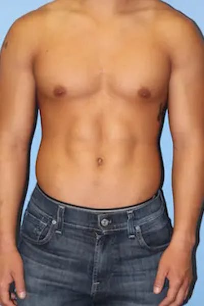 Liposuction Before & After Gallery - Patient 269893 - Image 2