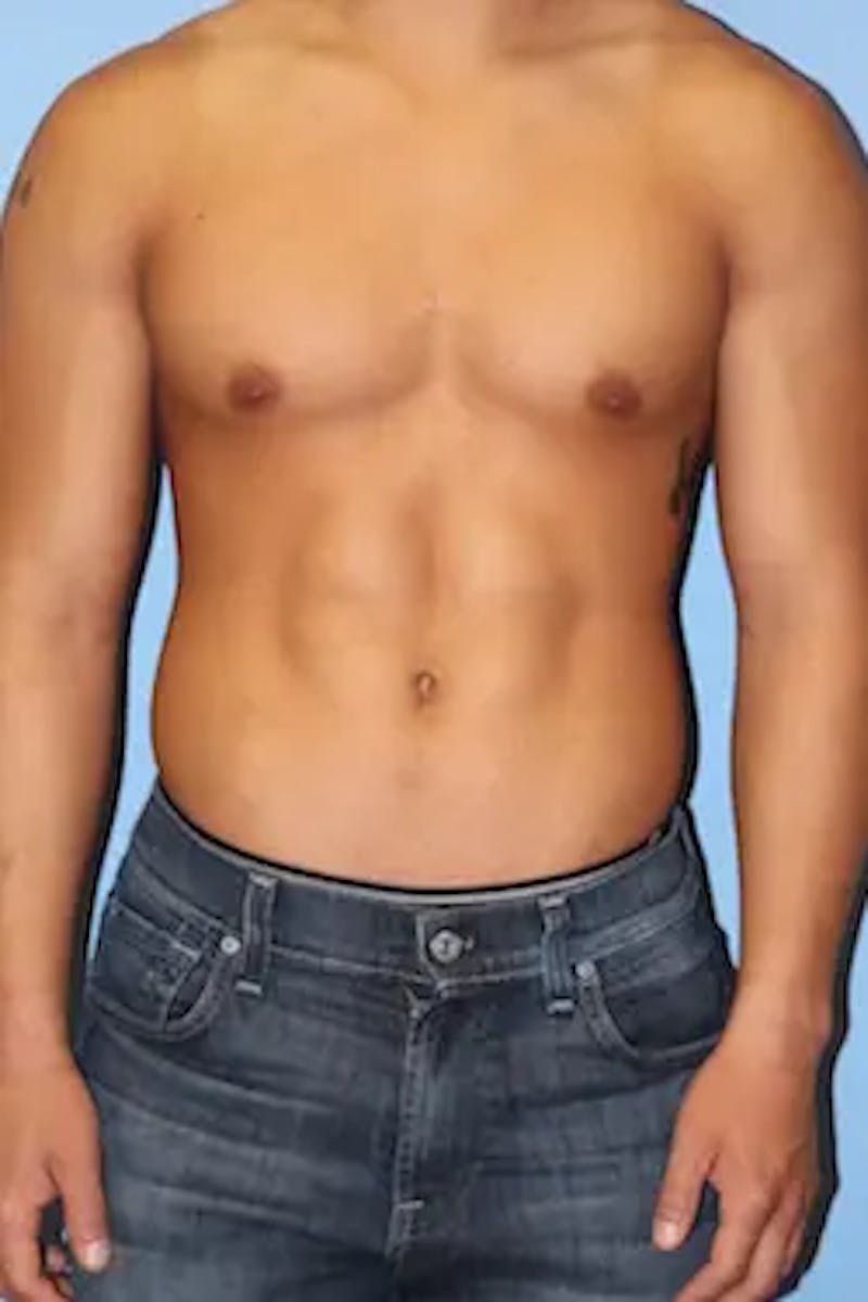 Liposuction Before & After Gallery - Patient 269893 - Image 2