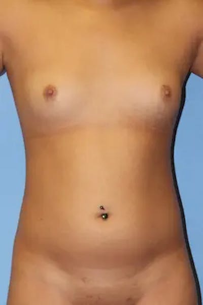 Liposuction Before & After Gallery - Patient 273734 - Image 1