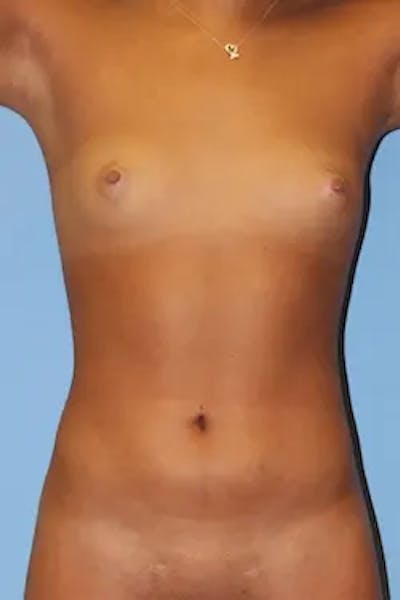 Liposuction Before & After Gallery - Patient 273734 - Image 2