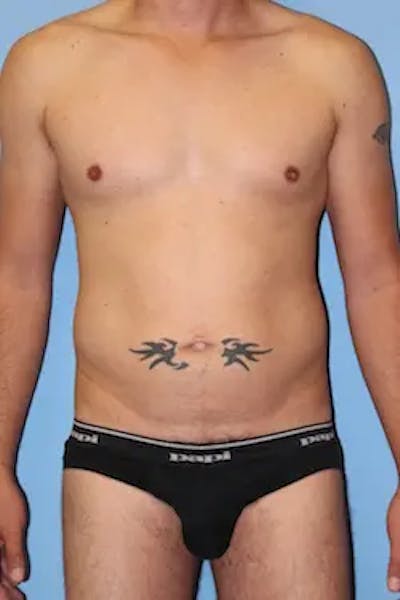 Liposuction Before & After Gallery - Patient 201729 - Image 1