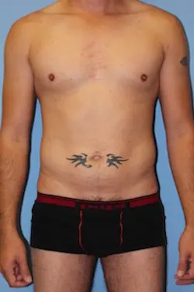 Liposuction Before & After Gallery - Patient 201729 - Image 2