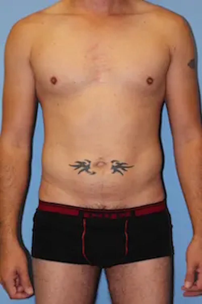 Liposuction Before & After Gallery - Patient 201729 - Image 2