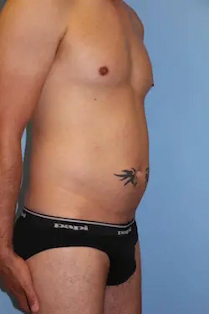 Liposuction Before & After Gallery - Patient 201729 - Image 3