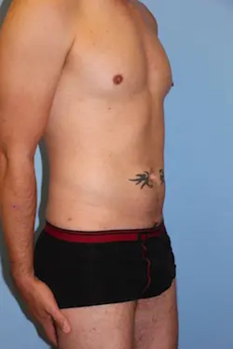 Liposuction Before & After Gallery - Patient 201729 - Image 4