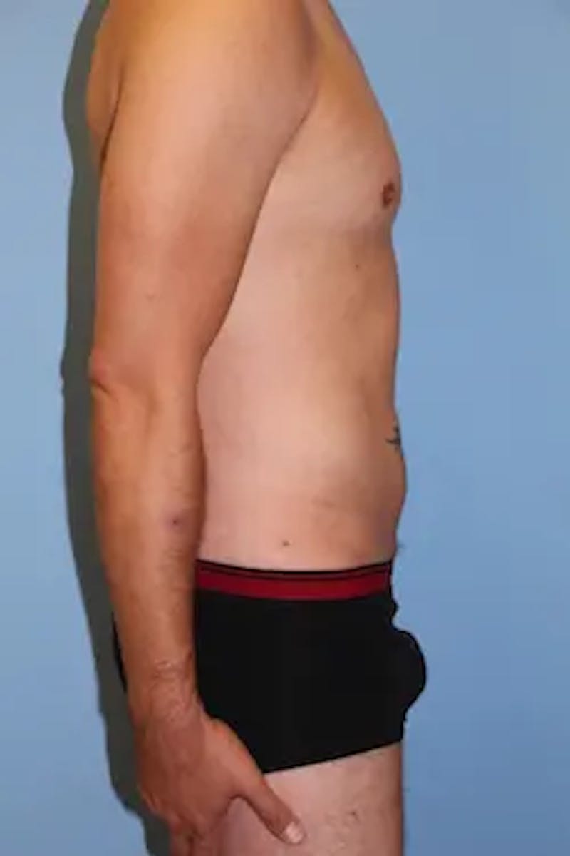 Liposuction Before & After Gallery - Patient 201729 - Image 6