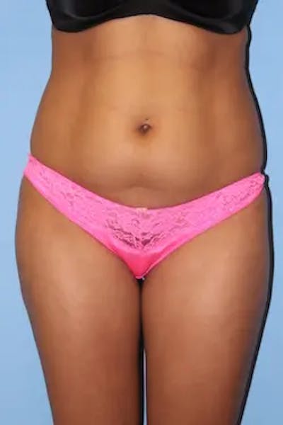 Liposuction Before & After Gallery - Patient 224353 - Image 1