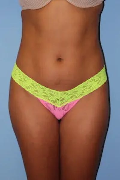 Liposuction Before & After Gallery - Patient 224353 - Image 2