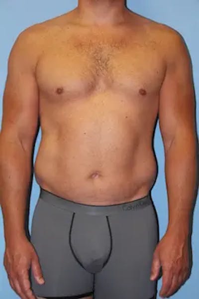 Liposuction Before & After Gallery - Patient 146968 - Image 1