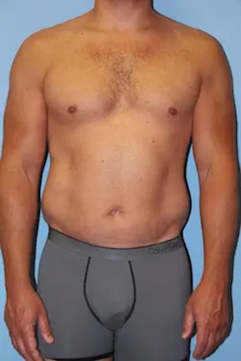 Liposuction Before & After Gallery - Patient 146968 - Image 1