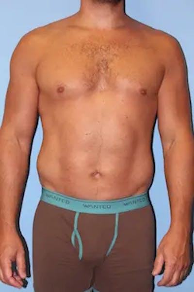 Liposuction Before & After Gallery - Patient 146968 - Image 2