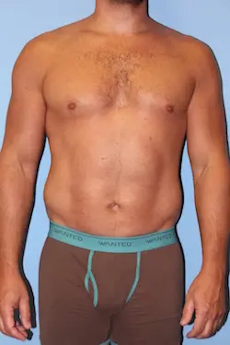 Liposuction Before & After Gallery - Patient 146968 - Image 2