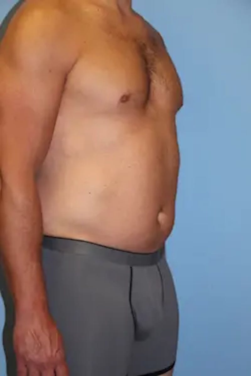 Liposuction Before & After Gallery - Patient 146968 - Image 3
